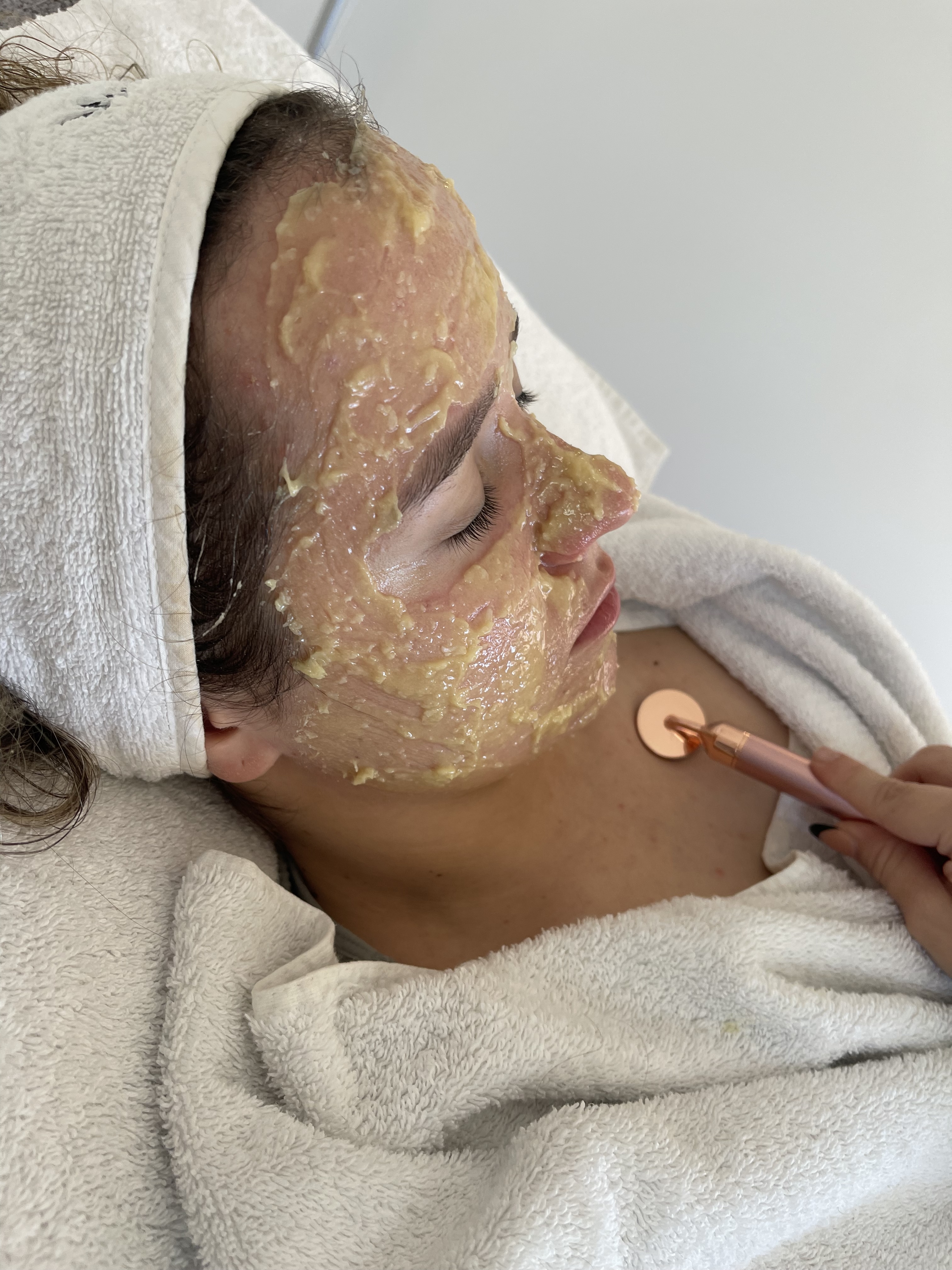 Clinical Skin Peels
